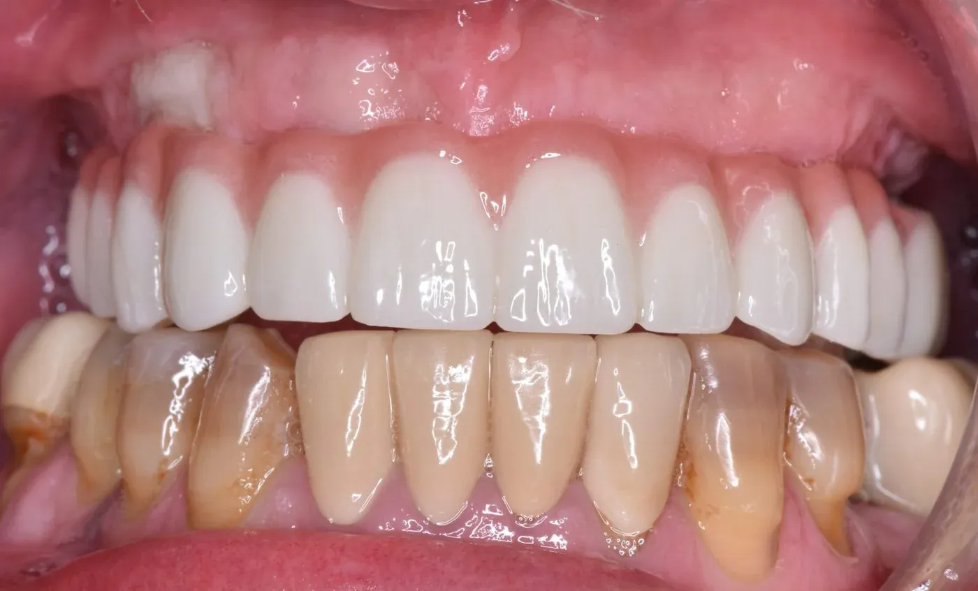Full-arch implant treatment — after treatment