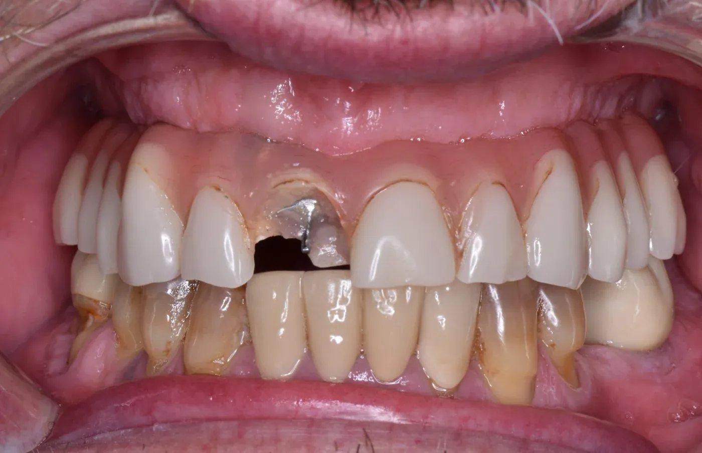 Full-arch implant treatment — before treatment