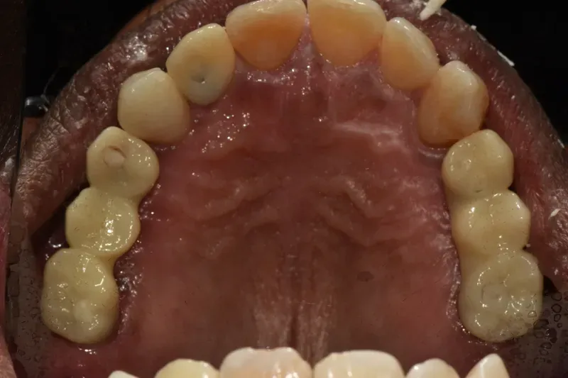 Upper arch implant treatment (view from below) — after treatment