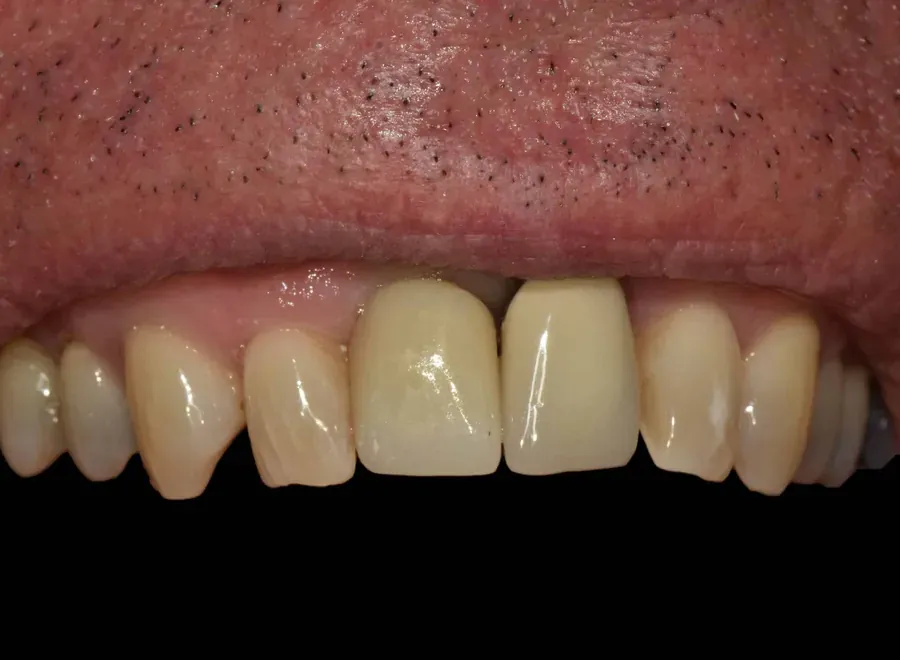 Front teeth restoration with ceramic crowns — after treatment