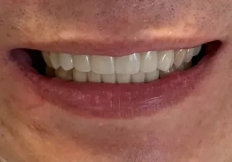 Full-arch smile rehabilitation — after treatment
