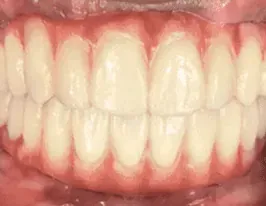 FP1 full-arch bridge, close-up