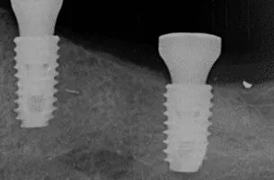 X-ray of a dental implant
