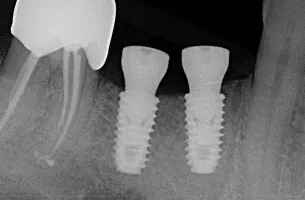 X-ray of two implants