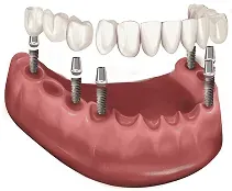 Illustration of a 3-On-6™ bridge on implants