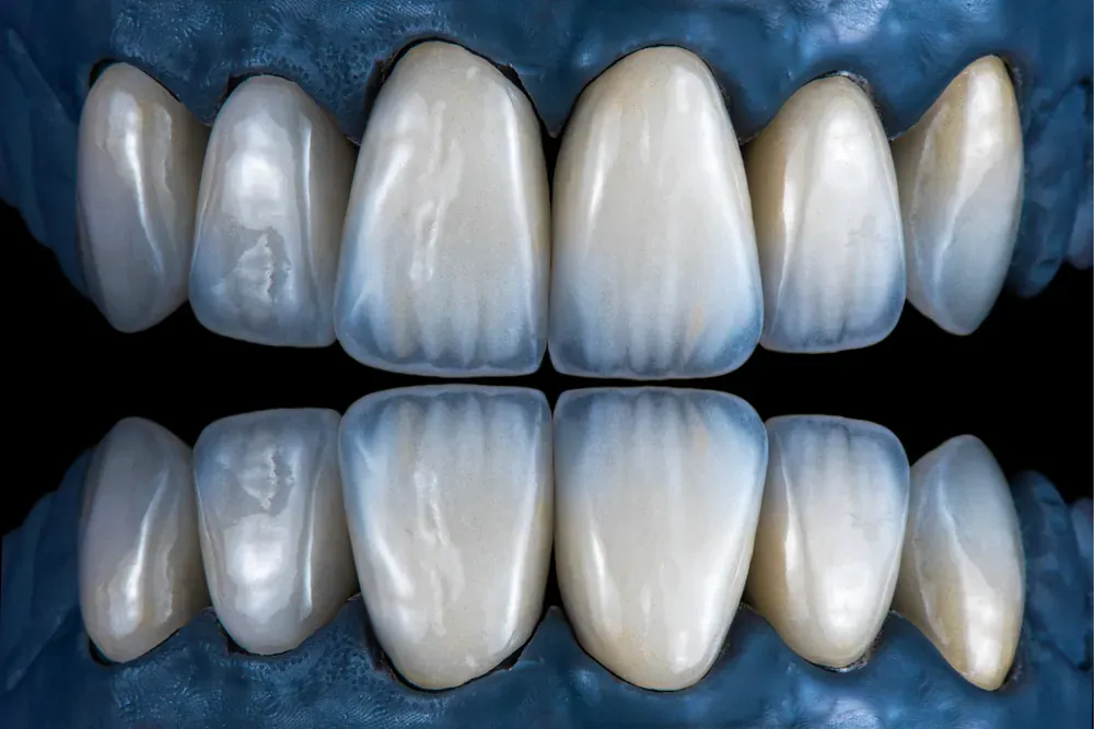 Porcelain veneers