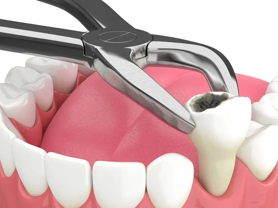 Illustration of a wisdom tooth extraction